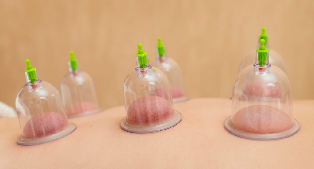 Patient avec 6 ventouses posées sur le dos lors d'une séance de cupping therapy