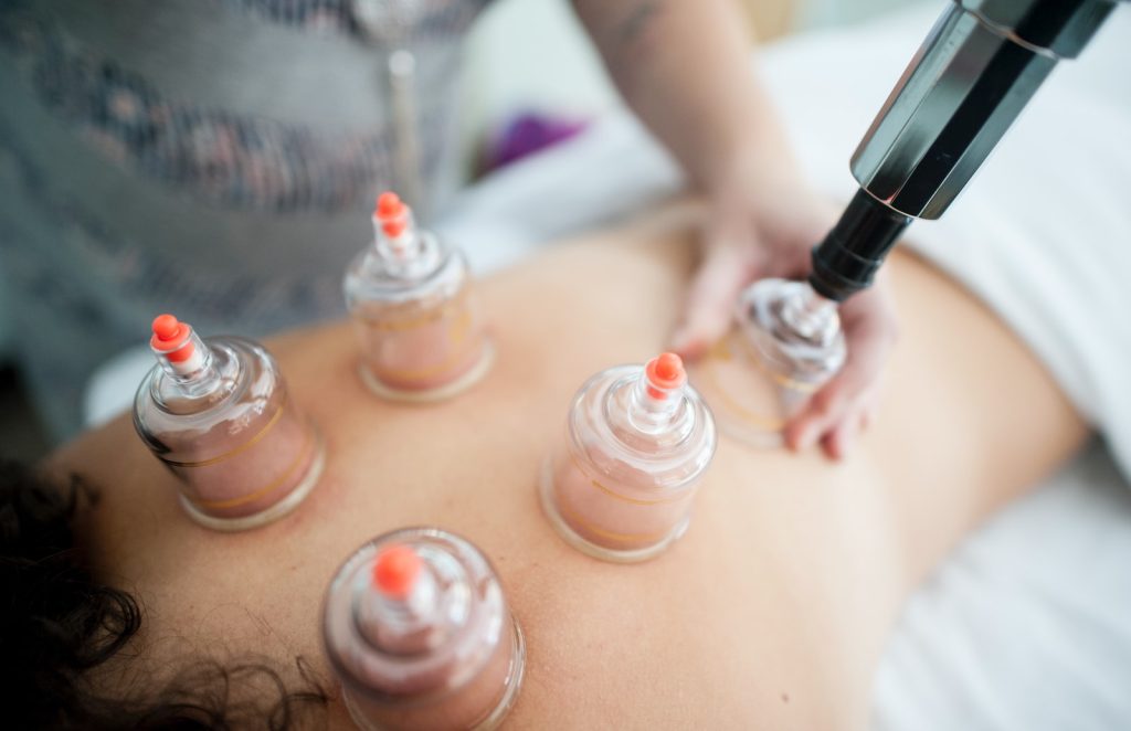 Praticien hijama qui pose des ventouses sur le corps d’une personne